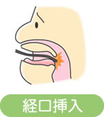 経口挿入