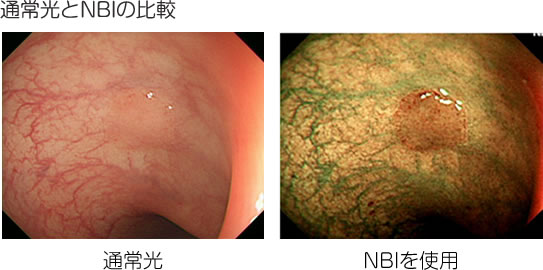 通常光とNBIの比較